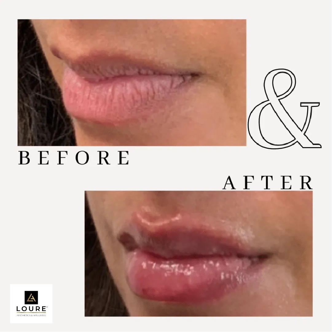 Before & After Lip Treatment