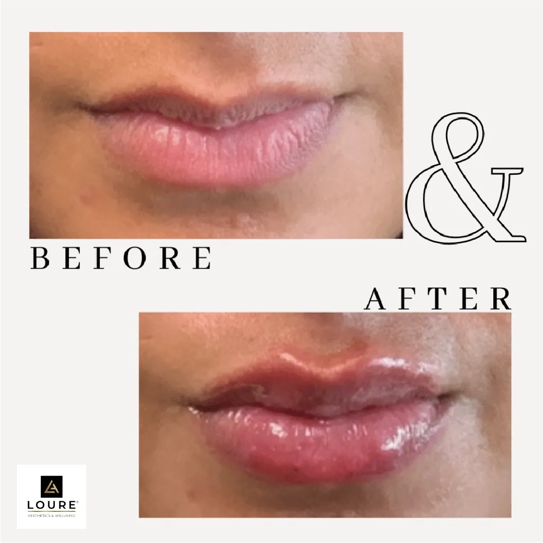 Lip Fillers