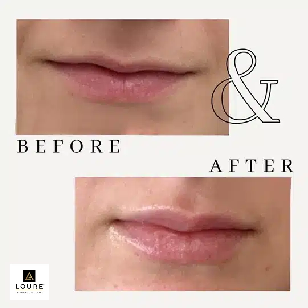 lip fillers