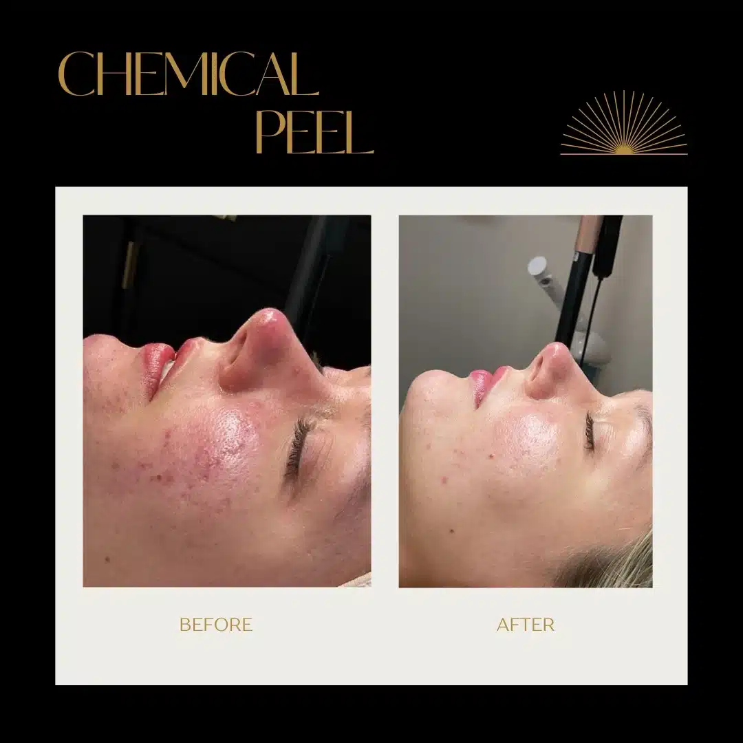chemical peel loure aesthetics1