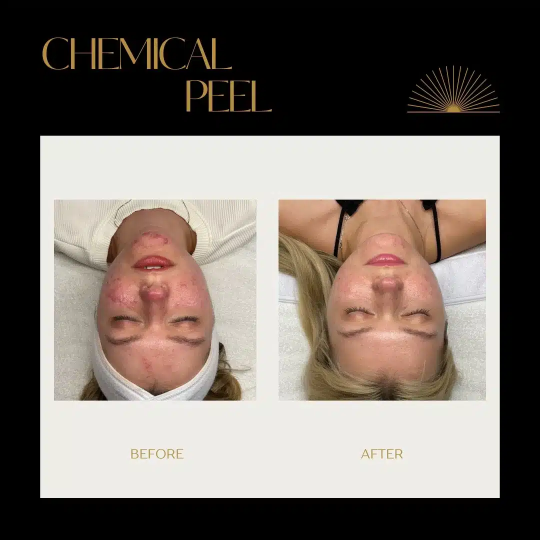 chemical peel loure aesthetics2