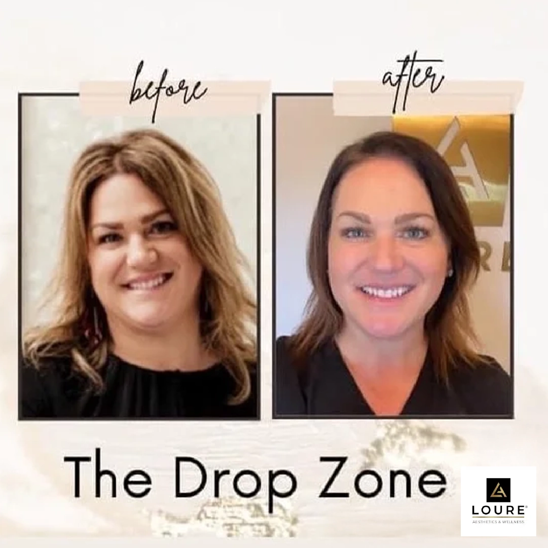 The Drop Zone Weight Loss Clinic in Waunakee, WI 15 Before and After Chin